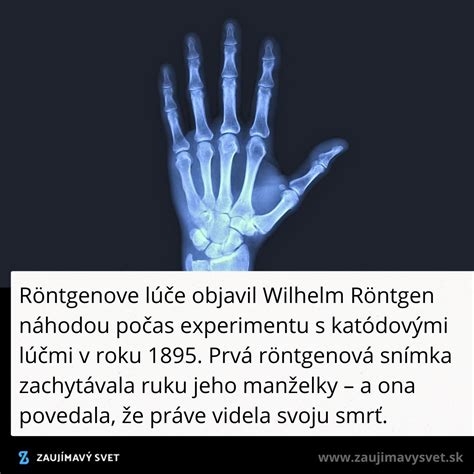 Röntgenová snímka ruky na určenie kostného veku