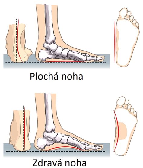 Schéma detských nôh s vyznačenými deformitami (O-nohy, X-nohy, ploché nohy)