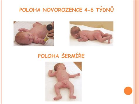 Asymetrická poloha novorodenca