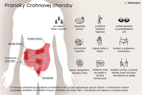 Grafické znázornenie Crohnovej choroby