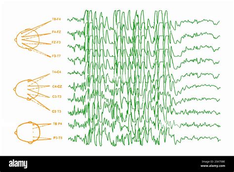 Schéma chirurgickej liečby epilepsie (rezonancia, PET, EEG)