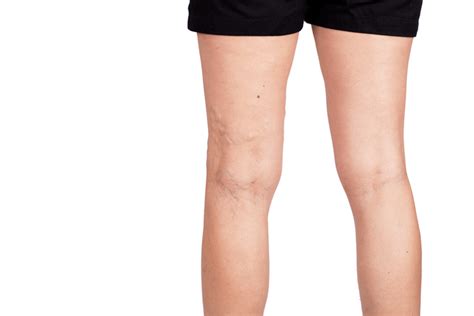 Ilustrácia opuchnutých nôh s kŕčovými žilami