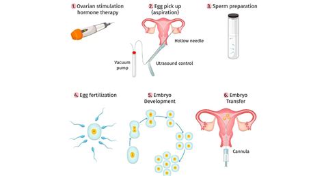 Schéma komplikácií po IVF