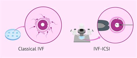 Schéma procesu IVF s vyznačením PGT