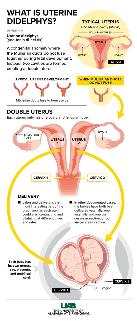 Schematické znázornenie uterus didelphys