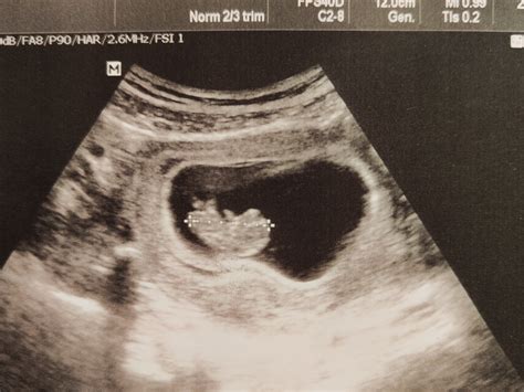 Schéma morfologického ultrazvuku