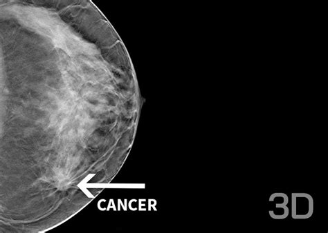 Vizualizácia mamografie a ultrazvuku prsníka