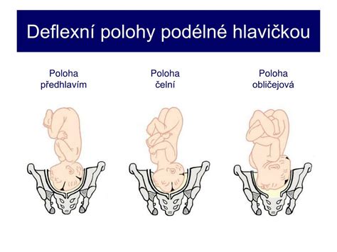 Schéma panvy s vyznačenými úrovňami hlavičky plodu pri pôrode