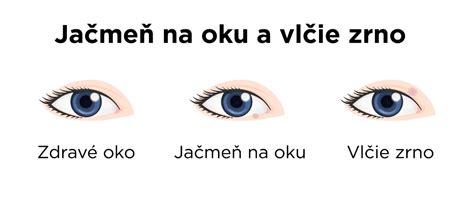 Infografika zobrazujúca rôzne príčiny zápalu očí