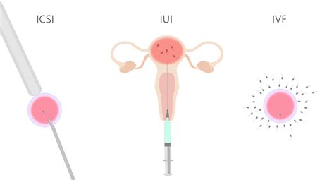 Porovnanie metód IUI, IVF a ICSI