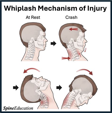 Ilustrácia whiplash injury