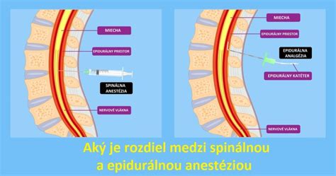 Epidurálna anestézia