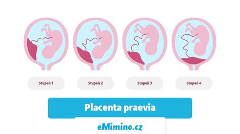 Mapa znázorňujúca rôzne typy uloženia placenty v maternici, vrátane placenta praevia