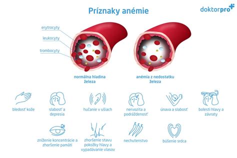 Infografika s vyznačenými rizikovými skupinami detí ohľadom nedostatku železa