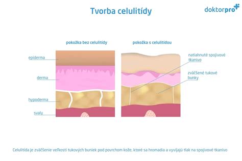 celulitída na stehnách