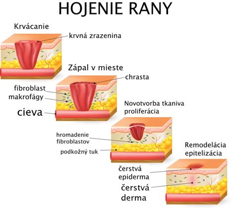 infografika zobrazujúca proces hojenia rany po cisárskom reze