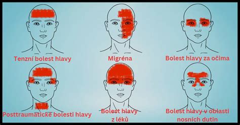 Ilustrácia ženskej hlavy s vyznačenými oblasťami bolesti