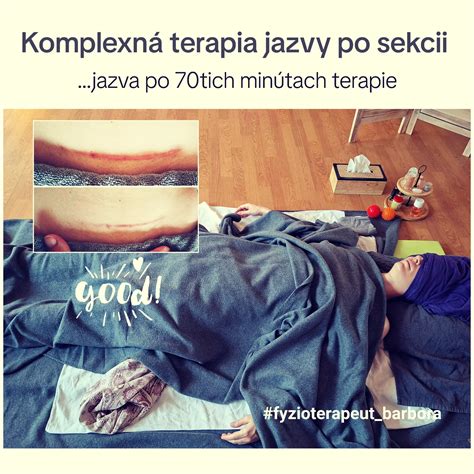 infografika o problémoch po cisárskom reze