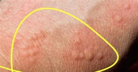 Ilustrácia rôznych príznakov histamínovej intolerancie