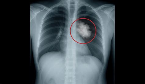 Podanie kortikosteroidov na dozrievanie pľúc plodu