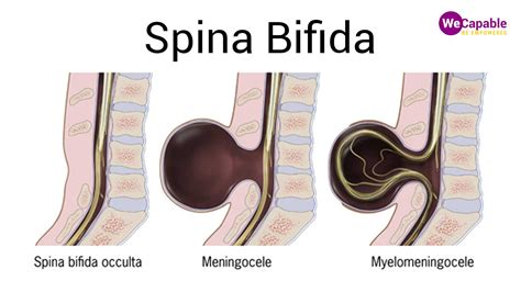 Rôzne typy spina bifida