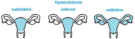 Infografika znázorňujúca rôzne typy hysterektómie (abdominálna, vaginálna, laparoskopická)