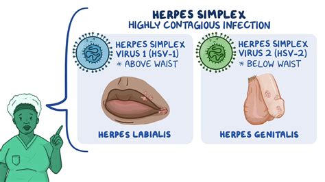 Infografika o vírusoch herpes simplex a ich prenose