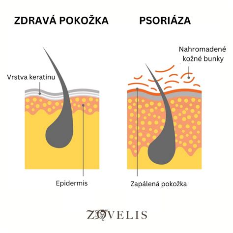 Ilustrácia strií na pokožke