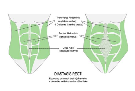 Diastáza brušných svalov