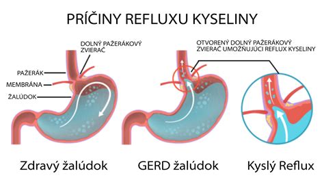 Schéma refluxu pažeráka