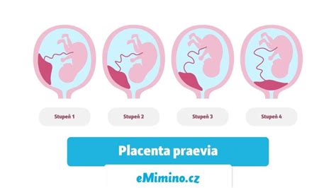 Ultrazvukové zobrazenie placenty praevia