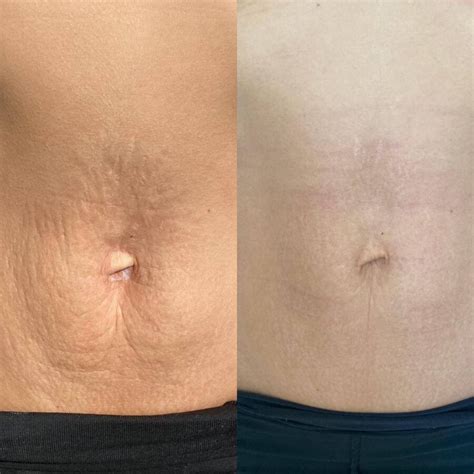 Špirála strií na pokožke