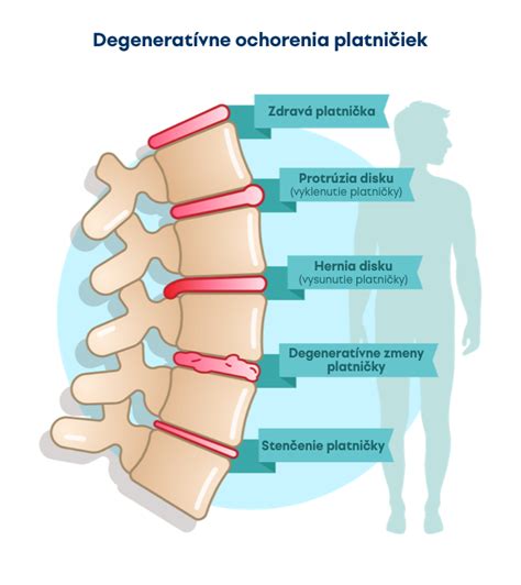 Schéma chrbtice s vyznačením platničiek
