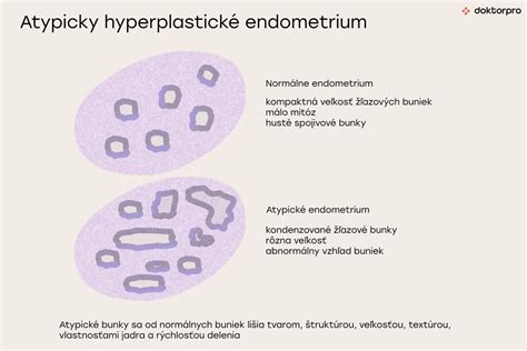 Infografika o rizikových faktoroch hyperplázie endometria
