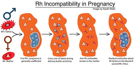 Porovnanie Rh+ a Rh-