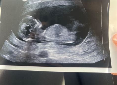 Ilustrácia páru pozerajúceho sa na ultrazvukové fotografie