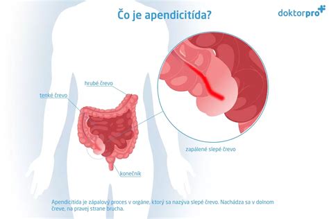 Príznaky zápalu pupka