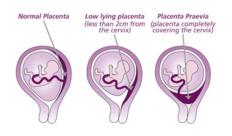 Schematické znázornenie placenta praevia