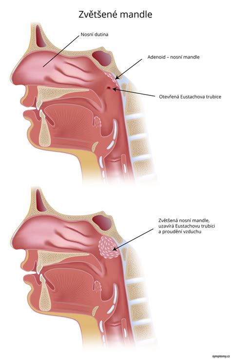 Schéma zväčšenej nosnej mandle