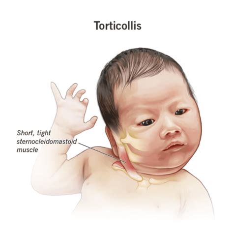 Ilustrácia dieťaťa s torticollis