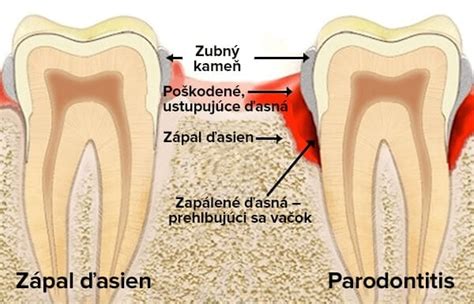 Schéma ochorenia ďasien - od gingivitídy po parodontitídu