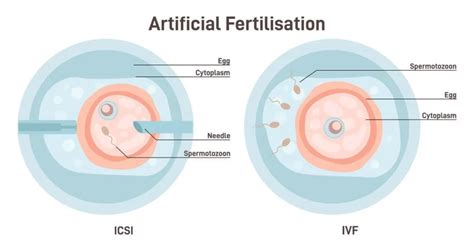 Schéma priebehu krátkeho IVF protokolu