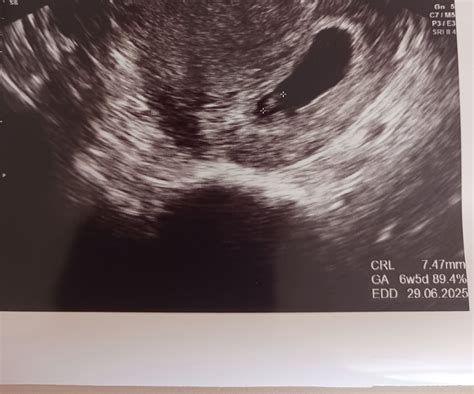 Ultrazvukový snímok embrya v 7. týždni