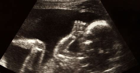 bábätko si cmúľa palček na ultrazvuku