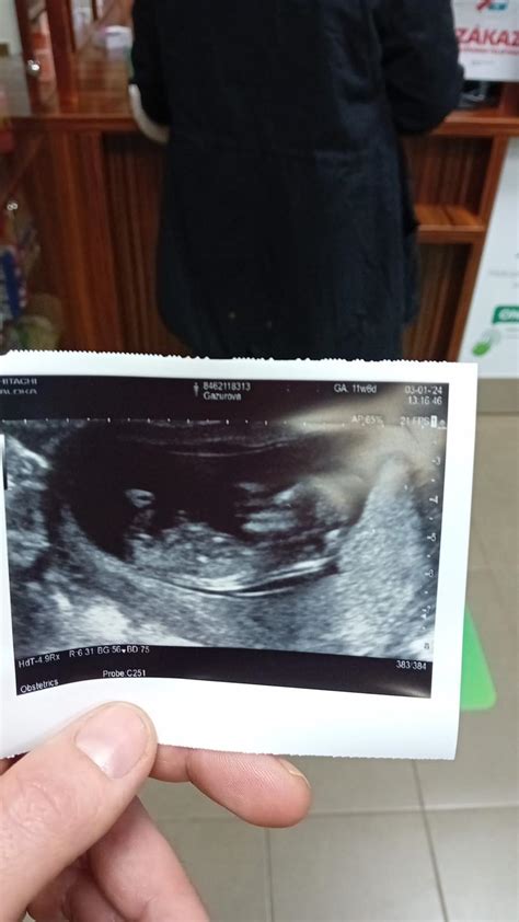 ultrazvuk bábätka s plačúcou tvárou