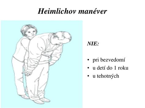 Schéma znázorňujúca Heimlichov manéver pri dieťati
