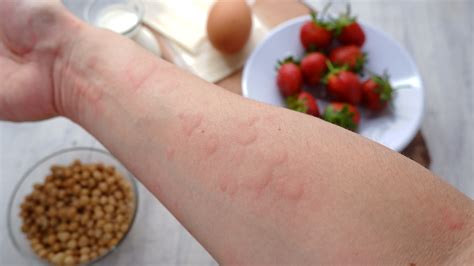 Schéma vysvetľujúca proces alergickej reakcie v tele