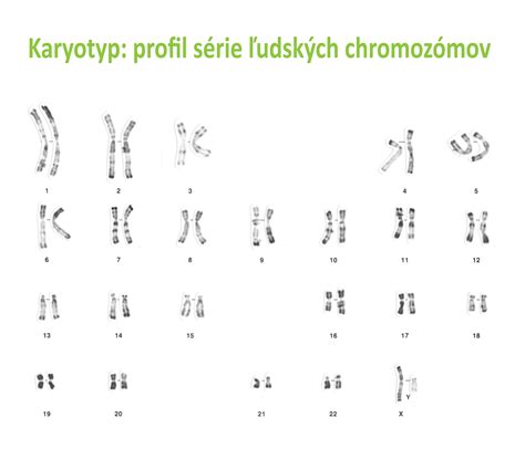 Ilustrácia chromozómov, zobrazujúca tri kópie 21. chromozómu