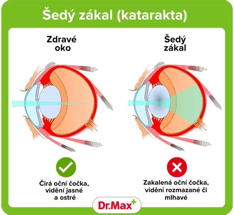 Porovnanie zdravého oka a oka s refrakčnou chybou