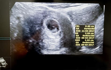 Ultrazvukový snímok embrya v 6. týždni tehotenstva